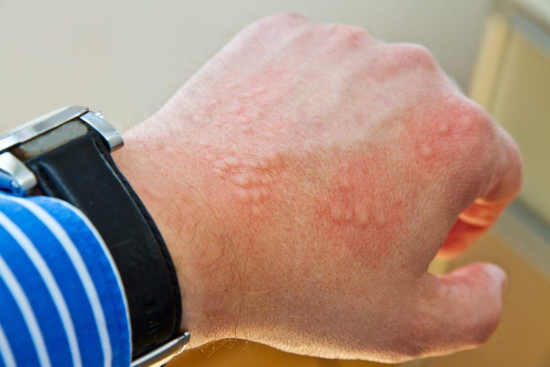 An Adult With A Rash AND A Fever: Go To the ER - Robert Cohen | Manual